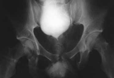 (D) CT shows that the final seating of SI screw gives reduction of the diastasis. 고찰불안정하고전위된골반환손상의특징은고에너지손상으로발생되며, 출혈량이많아사망률또한높고, 기타신체다른장기의동반손상이흔하며, 합병증및후유증을남길수있다.