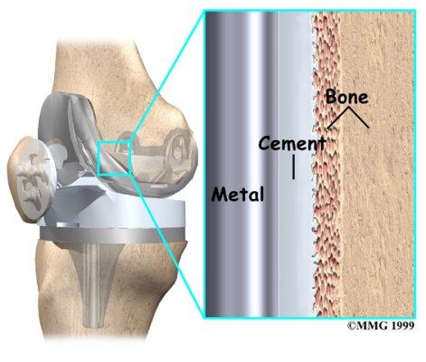 Artificial Knee Joint Cemented
