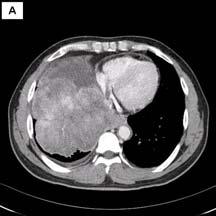 TH Lee et al: A case of huge pulmonary blastoma with multiorgan