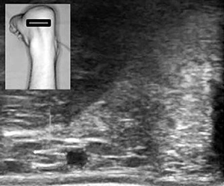 524 Dong Hun Kang, et al. B C D A Figure 2. (A) Surgical scene of intra operative ultrasound-guided percutaneous repair of the left Achilles tendon.