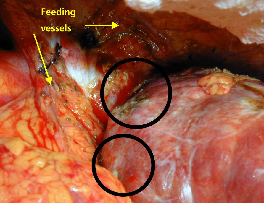 대한간암연구회지 2009년 제9호 A B C D Fig. 2. The operative and microscopic findings after 2nd operation (A). Two feeding vessels into tumor were found (B).