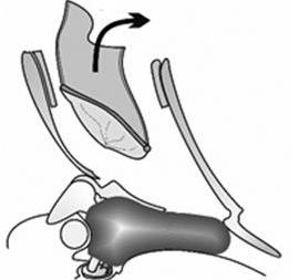 부분마취하에가장큰이경 (ear speculum) 을넣고외이도피판을 U자형으로만들어거상후중이를노출하게됨. 외이도가작다면후이개접근법을이용한외이도확장술을같이시행할수있다.