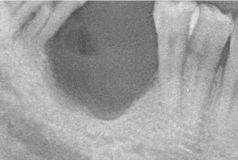 Intraoral photograph 6 month after bone graft. 60.86±13.