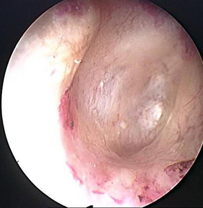 efore surgery, tympanic membrane shows necrotic central perforation and the middle ear