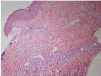 - 기영재외 4 인. 피하낭종과관절염을동반한 Sweet 증후군 - A B Figure 3. (A) Diffuse neutrophilic infiltration in a skin biopsy of the back (HE stain, 40).