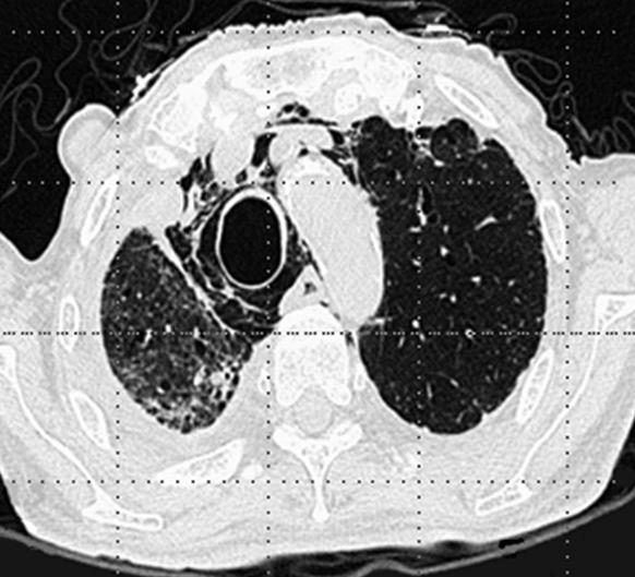 SR Jeon et al: Tracheomegaly and recurrent pneumomediastinum combined with pulmonary fibrosis 성간질성폐섬유증은 1년전과비교하여악화되었고, 종격동에서수직의공기선이관찰되었다. 1년전의기관직경은 19.7 mm였으며, 내원당시는 26.