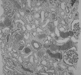 - 대한내과학회지 : 제 71 권제 2 호통권제 552 호 2006 - A B Figure 2. Light microscopic findings of the renal biopsy specimens.