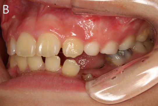 (B)(C)(D) Intraoral photograph after surgery. Fig. 3.
