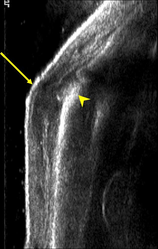 (D, E) On MRI of the finger, the proximal phalangeal head, mid phalangeal base and periarticular soft tissue of the PIP joint show low signal intensity on