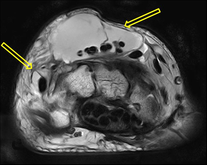 (B) On fat suppressed T1-weighted MR coronal scan of the wrist, pannus