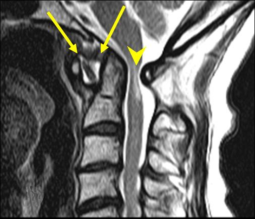 (arrowhead). 의경우에서는 acetabular protrusion과연골하낭종이생기고대퇴골경부에골증식이보인다 (Fig. 12).