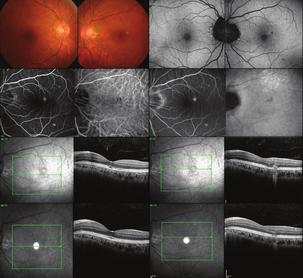 Kang HS, et al. Multimodal Imaging: MFC and PIC A B C D E F Figure 4. This 45-year-old myopic woman complained of blurred vision in the left eye. The first three rows (A-E) were obtained at baseline.