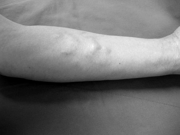 이우성외 Fig. 1. Preoperative photographic finding of anterior area of left forearm. 정맥으로추정되는혈관의전반적인확장을지니고있었으나박동등은관찰되지않았고, 진동및잡음등도관찰되지않았다 (Fig. 1).