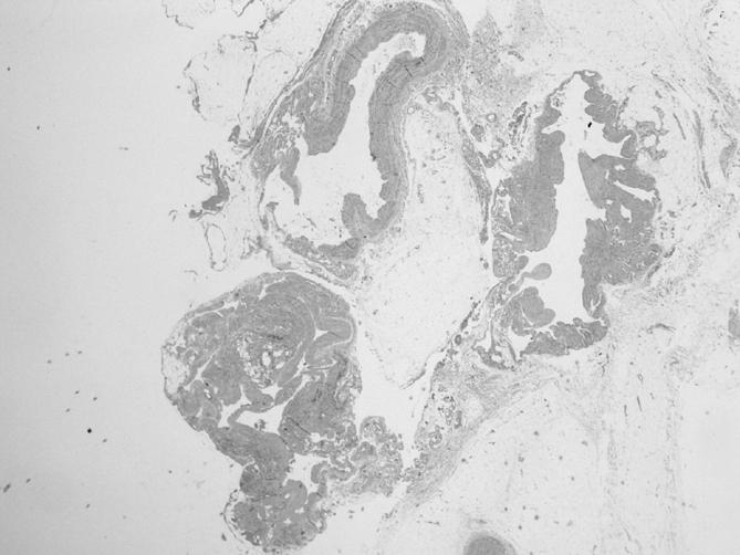 이우성외 Fig. 3. Histologic finding of resected phlebectasia. (A) Contains whole venous vessel component (H&E stain, 12.