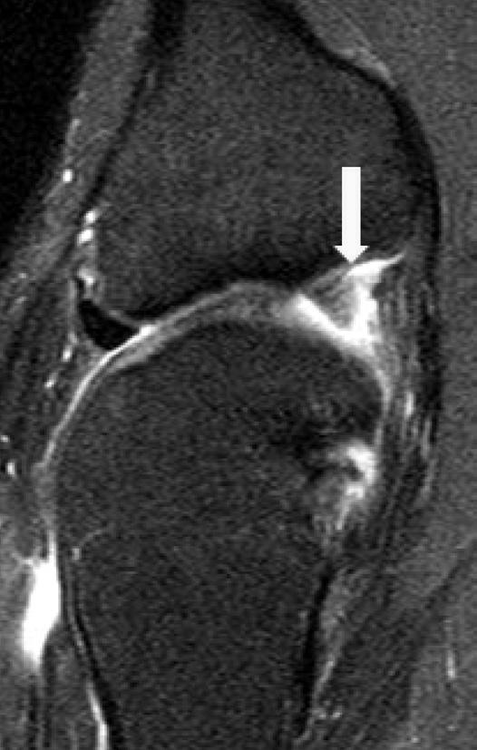 Axial image showing a high signal in the region of the posterior horn with a radial root tear (arrow). Figure 3.