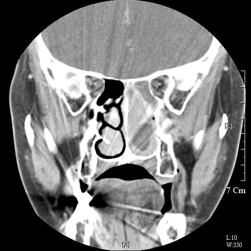 xial contrast enhanced image () and coronal contrast enhanced image () show heterogeneously enhanced tumor (arrows) at the left nasal cavity. 으나종물의침습은발견되지않았다.