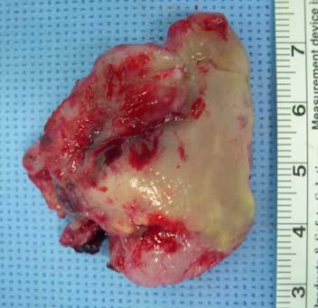 사골동에발생한일차성두개외수막종 C D Fig. 3.