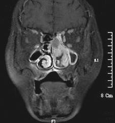 No intracranial involvement is observed (C, D). Fig. 4.