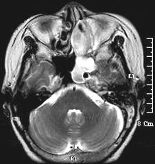 6-8) 본증례에서는수막종이단지비부비동에만존재하였고중추신경이나두개공 (skull foramina)