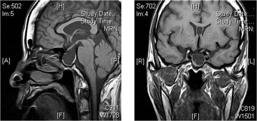 Sella MRI shows enlarged pituitary fossa totally replaced by cerebrospinal fluid. 하였기에보고하는바이다. 증례환자 : 68세, 여자환자주소 : 전신쇠약감현병력 : 환자는수개월부터전신쇠약감을주소로내원하여외형상하악골비대가의심되어말단비대증검사를위해입원하였다.