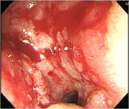 - Song Yi Kim, et al. A case of acromegaly with empty sella syndrome - A Figure 3. Colonoscopic and histological findings are shown.