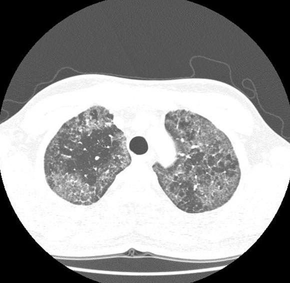 VATS lung biopsy.