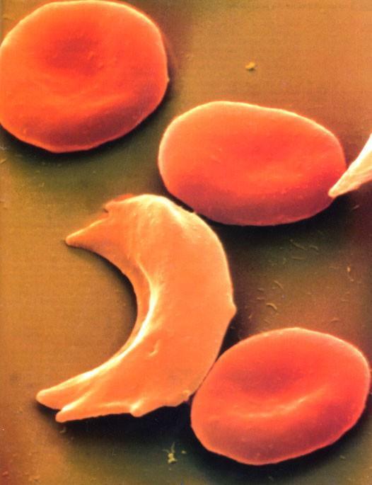 단백질과질병 단하나의아미노산에문제가생겨도질병을일으킬수있다. Normal Red Blood Cells 겸상적혈구빈혈 (Sickle cell anemia): 만성적혈구파괴, 감염에대한취약성, 장기손상그리고몇몇경우에는조기사망을일으키는유전성혈액질환.
