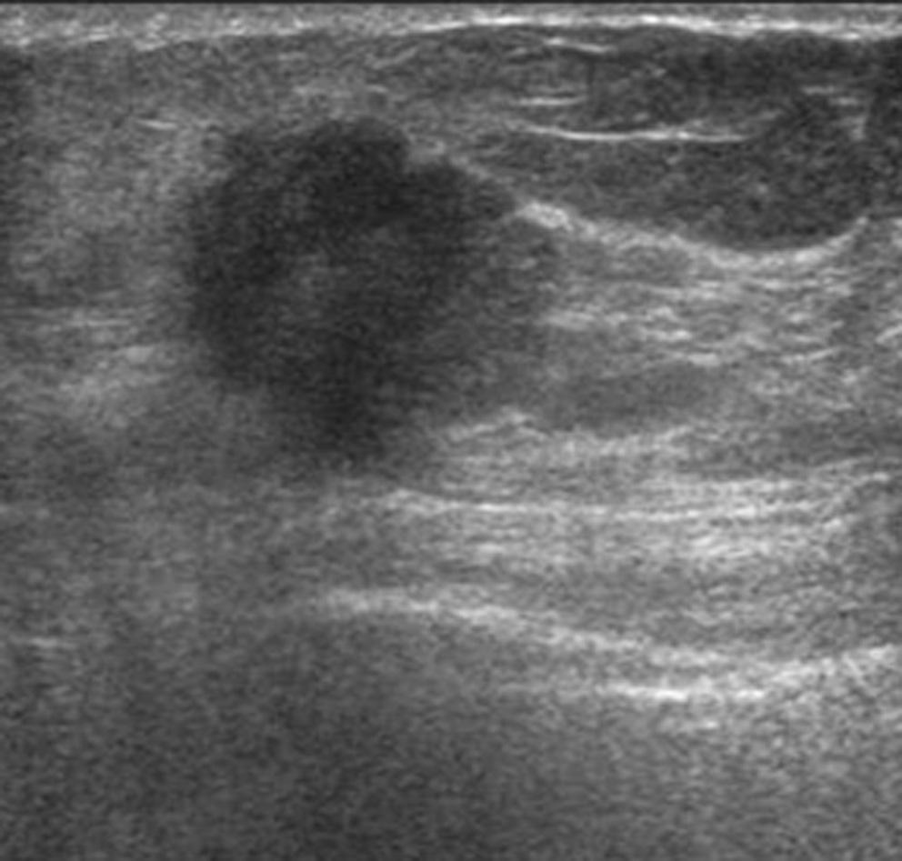 Both observers agreed completely; oval shape, parallel orientation, circumscribed margin, abrupt interface of lesion boundary, hypoechoic echo pattern, no posterior acoustic features and no