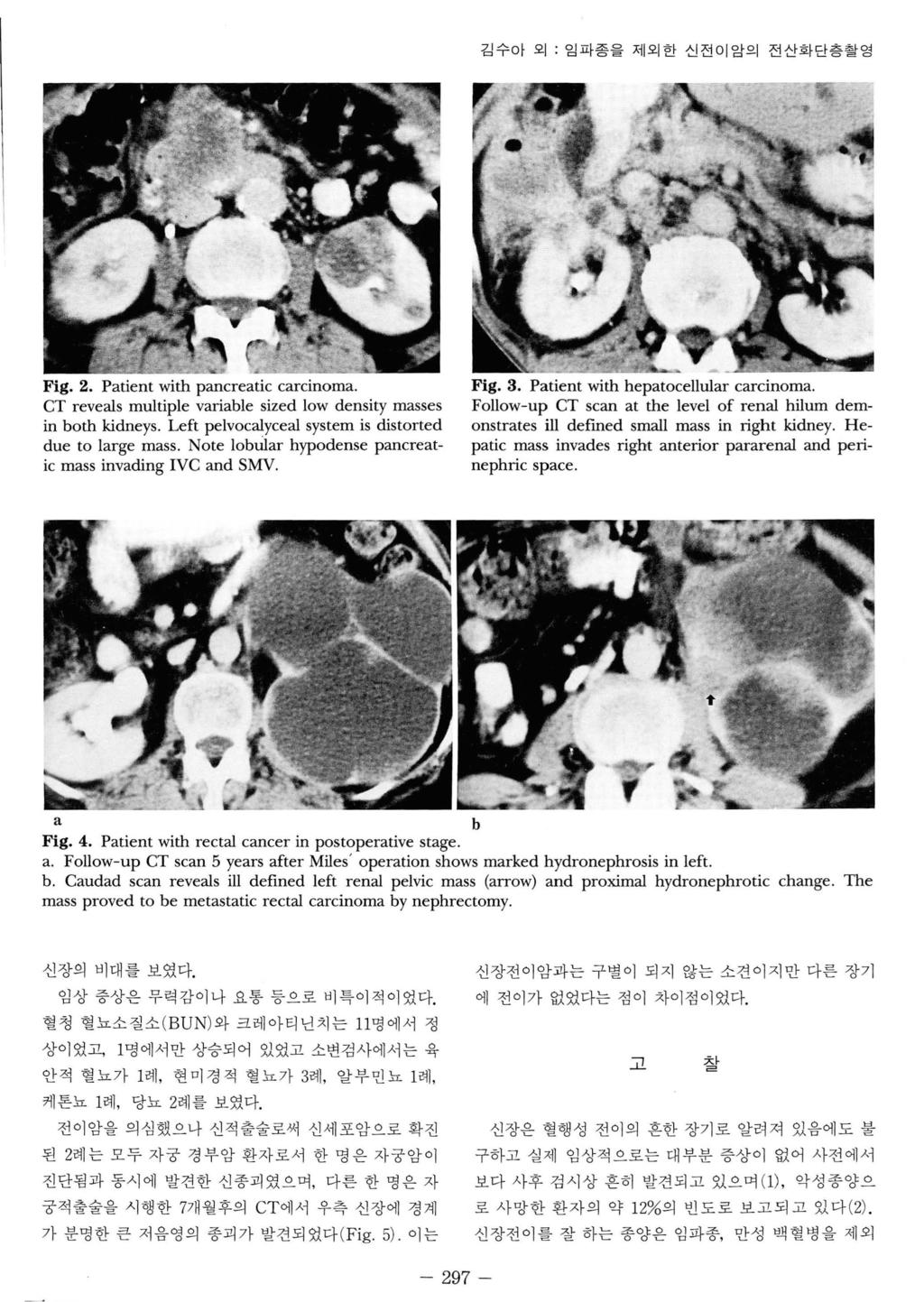 김수아외 : 임파증을제외한신전이암의전산화단층촬영 Fig. 2. Patient with pancreatic carcinoma. CT reveals multiple variable sized low density masses in both kidneys. Left pelvoc 띠 yceal system is distorted due to large mass.