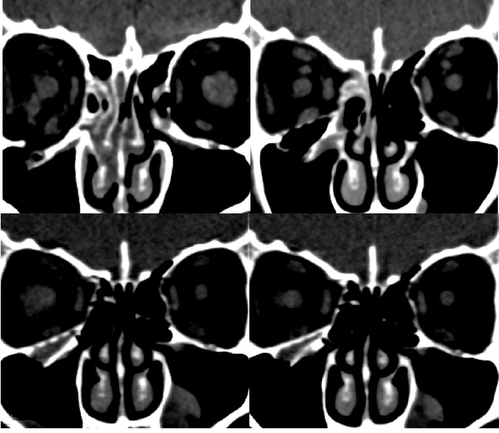 - 위재민외 : 골전도성안와삽입물의수술효과 - A B C D Figure 2. Serial orbital computed tomography. (A) Preoperative orbital CT shows a right floor fracture with herniated tissue into the maxillary sinus.