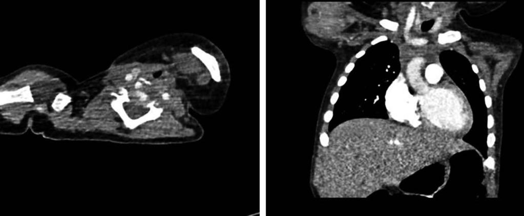대한소아응급의학회지제 1 권제 1 호 2014 Fig. 1. Chest computed tomography (CT) scan performed at the other hospital. Fig. 1. () xial images showed no remarkable abnormality.