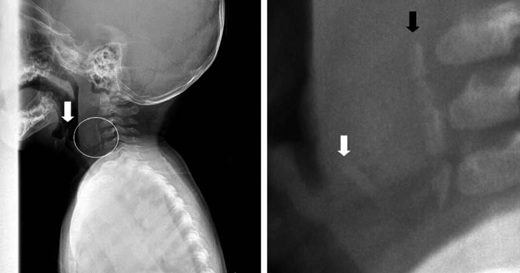 식도내잔류이물에의한지속적협착음을보인영아 1 례 Fig. 3. Initial lateral view of neck soft tissue x-ray. Fig. 3. White arrows indicate normal epiglottis.