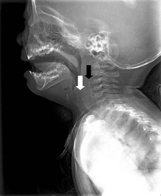 대한소아응급의학회지제 1 권제 1 호 2014 Fig. 5. Follow-up lateral view of neck soft tissue x-ray that was carried out at 7 days after foreign body removal. Fig. 5. White arrow indicates the hypopharynx that shows clearance of the radiopaque lesion.