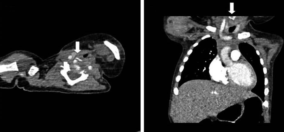 White arrows indicate the lesion. Fig. 8. Chest computed tomography (CT) scan outside the hospital. Fig. 8. radiopaque foreign body (white arrow) was recognized retrospectively from Chest CT scan that was carried out at the other hospital.
