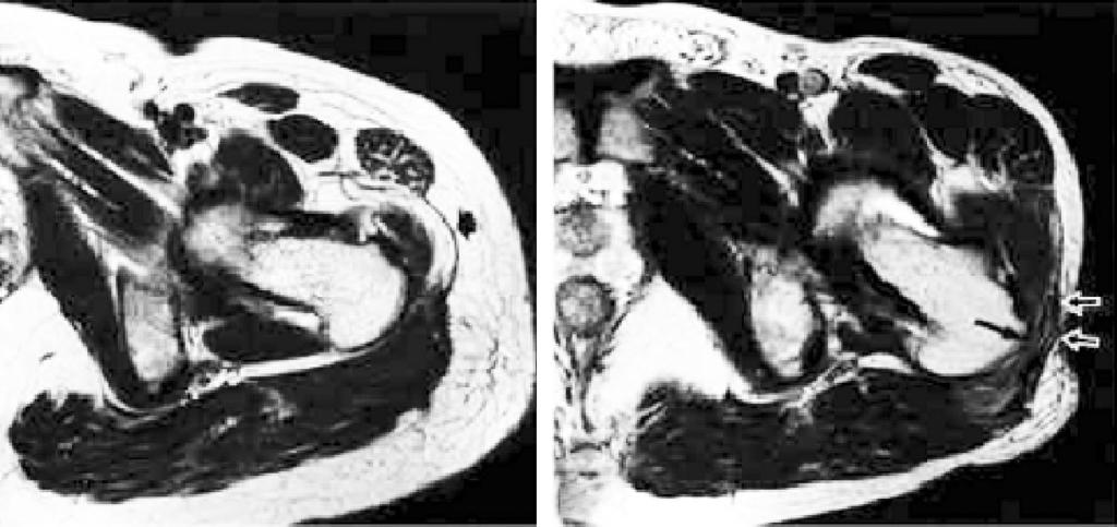 Kee-Haeng Lee: Soft Tissue Disease around the Hip 전방경계에압통이있다고보고하였다 6,64). 역동적초음파 (dynamic sonography) 를이용하여대부분의환자에서관절외부의원인 (extra-articular type) 을감별할수있다 11,46).
