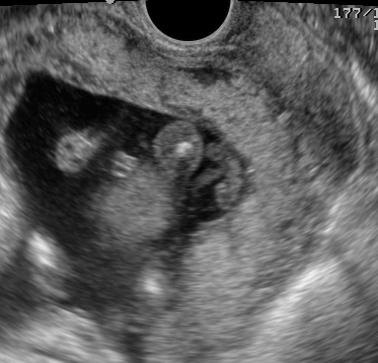 이증례는임신 36주에 placenta increta 로제왕절개전자궁적출술을시행받았다. Fig. 1. The gestational sac locates in the lower uterine segment of uterine cavity and ended up placenta percreta.