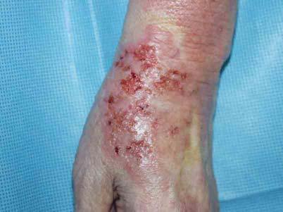 문형식등 : 피부프로토테카증 1 예 A Fig. 1. Painful ulcerative erythematous patch and crust on Lt.wrist and Lt.hand. 피부소견 : 좌측손목과손등에 8 10 cm 크기의홍반성판으로내부는황색의삼출물과가피로덮여있으며, 촉진시에압통을호소하였다 (Fig. 1).