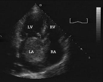 - Sung Gyu An, et al. sinus node dysfunction and atrial tachycardia after excision of the myxoma - A B C D Figure 1.