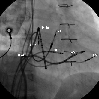 - 안성규외 6 인. 점액종수술후발생한부정맥치료 1 예 - A B Figure 6. Fluoroscopic position of the mapping catheter from the right (6A) and left anterior oblique views (6B).