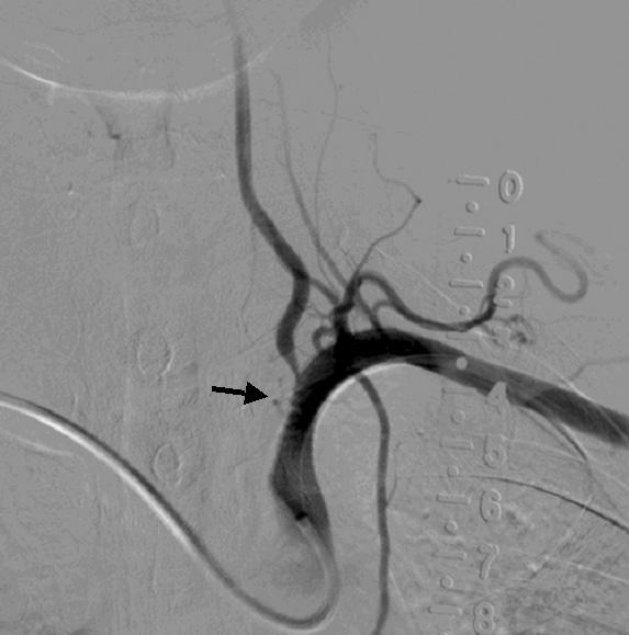 Retrograde filling of contrast from right vertebral artery into left vertebral artery 'disappeared' in the post-stent subclavian artery angiogram. Figure 4.