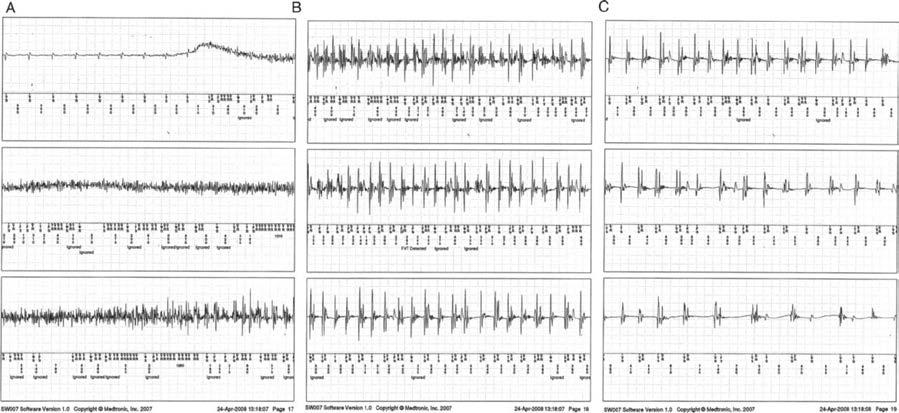 Figure 4. Electrocardiograms recorded in implantable loop recorder during tonic-clonic seizure. (A) Continuous muscle artifacts can be seen, indicating tonus.