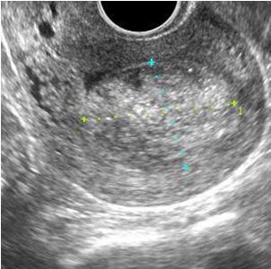 최윤진외 3 인. 3D volume 으로평가한 methotrexate 의치료효용성 A B Fig. 3. 2D & 3D TVS finding of remnant placenta after 2 nd methotrexate injection. The placenta size is 2.8 3.8 cm 2 and the volume is 15.849 cm 3.