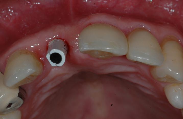 (A) Intraoral view after
