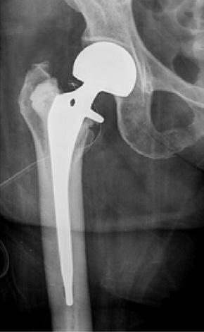 A (A) Osteolytic lesion associated with pathologic fracture was found