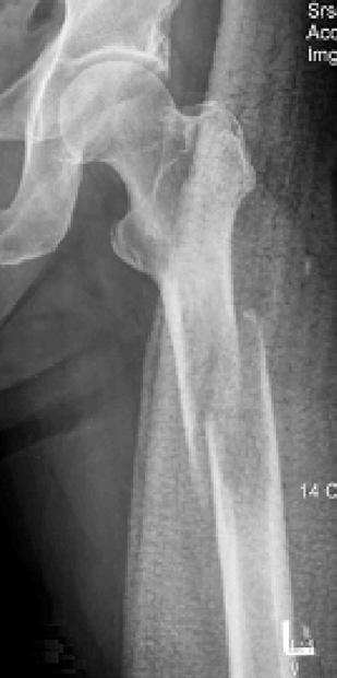 A (A) A pathologic fracture occurred in