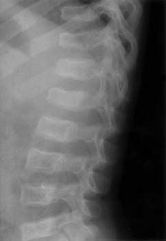(C) After 9 months of cyclic intravenous pamidronate treatment, the vertebral height was restored to some extent.