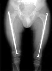(A) He sustained a right femur shaft fracture, and the left femur had been deformed by previous fractures.