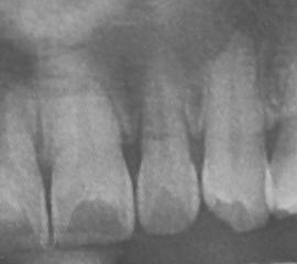 lateral incisor scheduled for