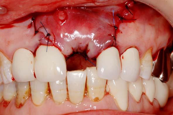 Figure 21. Primary closure was achieved. Figure 22. Pontic is splinted with approximal teeth. Figure 23. Provisional restoration was placed.
