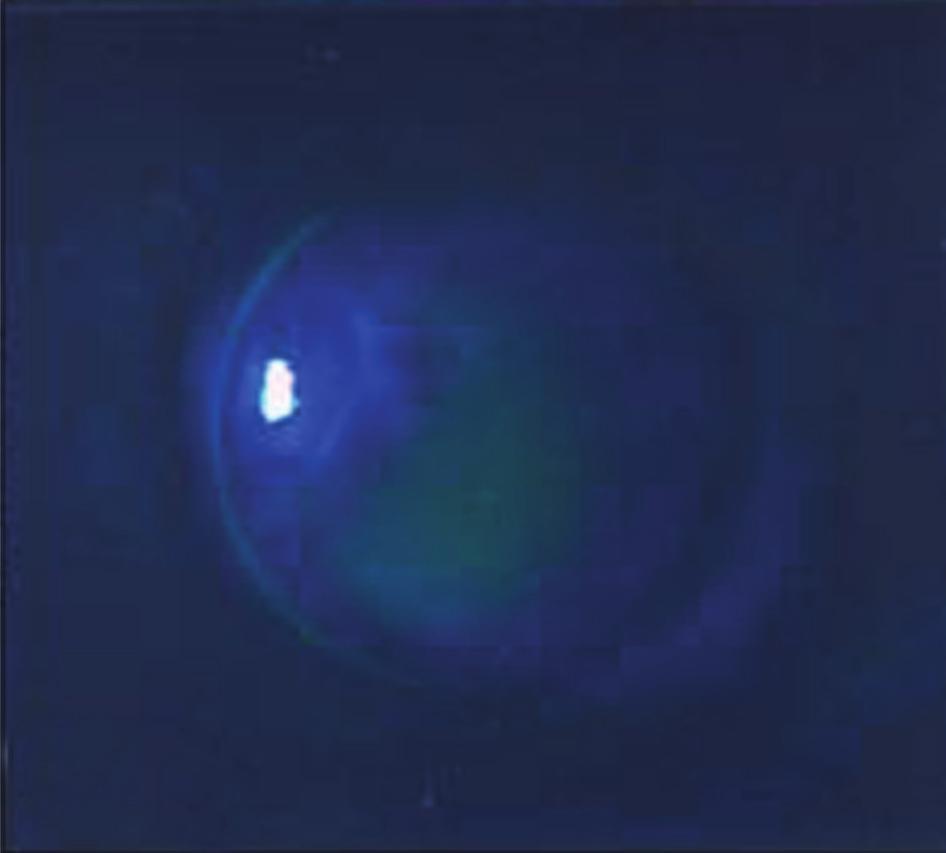 (A) Anterior segment photograph showing full-thickness corneal laceration with cornea touched iris in